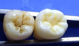 有蛀牙可以吃蜜瓜吗